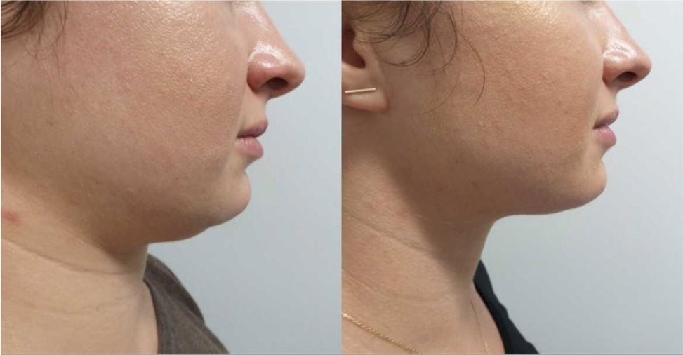 Before and after: Kybella, chin and jaw